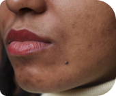Hyperpigmentation Dark Marks Secondary to Acne