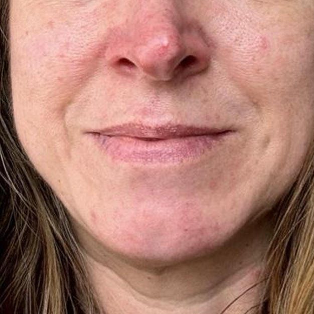 Rosacea 4 Weeks After