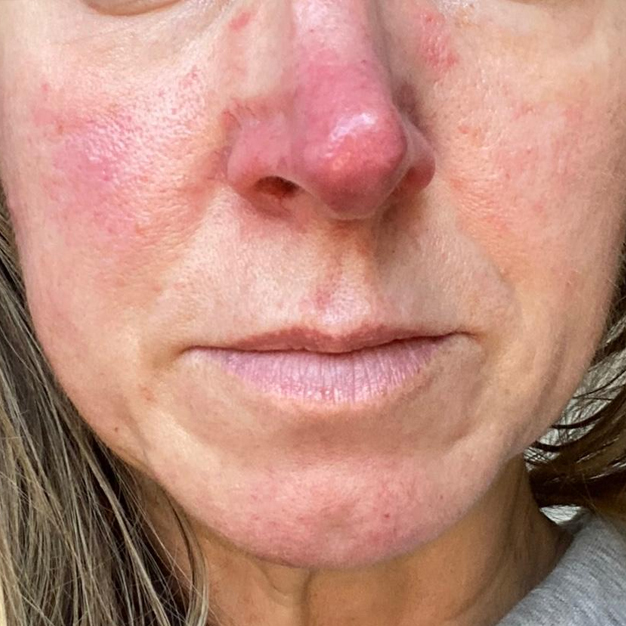 Rosacea 4 Weeks Before